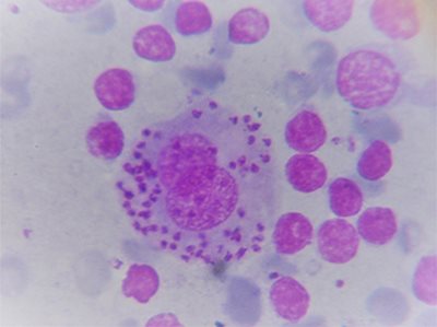 Ponction d'un énorme ganglion / Dermatlogie - Clinique du Vernet