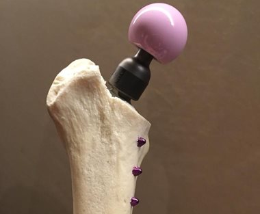 Prothèse totale de hanche - Clinique du Vernet